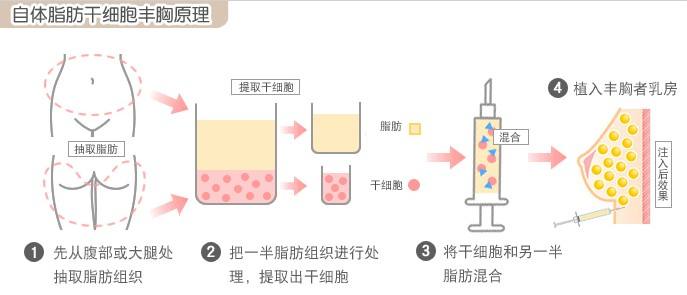 自体脂肪隆胸原理