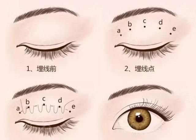 眼睛变好看,竟是因为埋了一根线