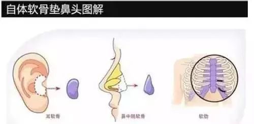 她用膨体隆鼻后,男友惊呆了